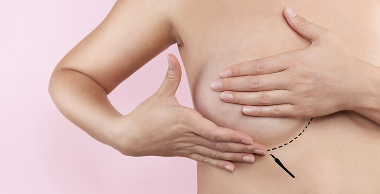 Breast Augmentation Incision Placement